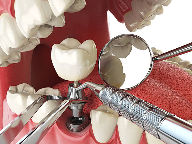 Best Emergency Tooth Extraction in Milford, OH